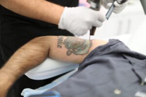 Advanced PicoSure Laser Treatments for Complete Tattoo Removal