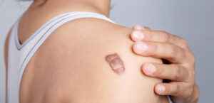 Burn Reconstructive Surgery A New Beginning for Survivors