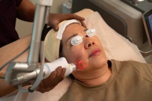 Fractional CO2 Laser Treatment for Fine Lines and Wrinkles