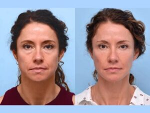 Look Younger Instantly with Thread Lift Treatment in Dubai