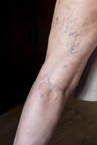 Reduce Vein Visibility with Sclerotherapy