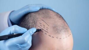 Why FUE Hair Transplant Is the Preferred Choice