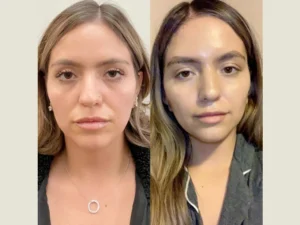 Natural-Looking Results with Thread Lift at the Best Aesthetic Clinic in Dubai