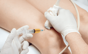 Pain-Free Knees with PRP Injections