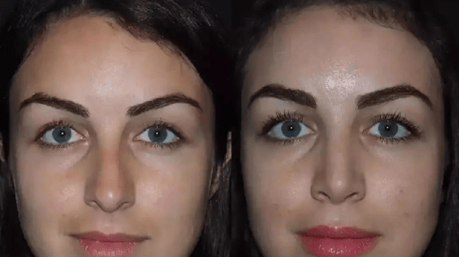 best rhinoplasty sugeon in dubai