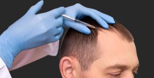 Safe and Proven Hair Fillers Treatment