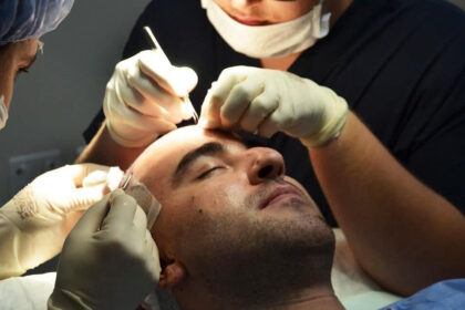 Hair Transplant in Dubai