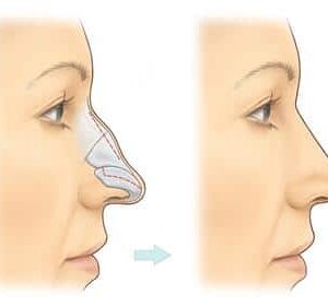 Rhinoplasty in Islamabad