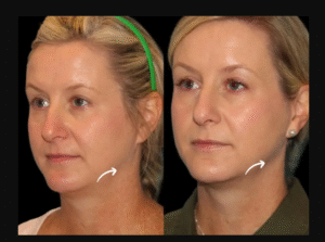 Sculptra Fillers Treatments in Dubai