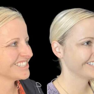 Your Guide to the Best Doctors in Dubai for Botox Treatments