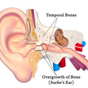 Surfers Ear Surgeon