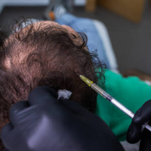 PRP Hair Treatment in Abu Dhabi