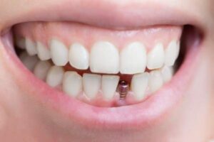  dental implants Truro