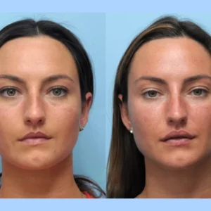 Elevate Your Look with the Best Doctors in Dubai for Thread Lift