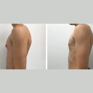 Gynecomastia surgery