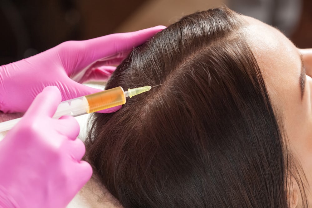 Best PRP Hair Treatment in Dubai