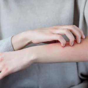 Clear Scabies and Worms Safely with Ivermectin 12 mg
