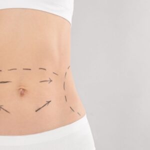 Tummy Tuck in Dubai