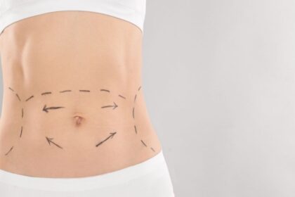 Tummy Tuck in Dubai