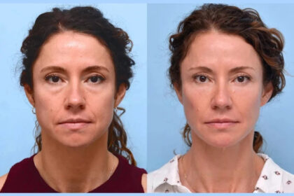 How Thread Lift Treatment in Dubai Can Help With Acne Scarring and Skin Texture