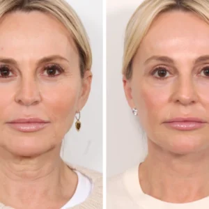 Best Plastic Surgeon in Dubai: Key Factors to Consider Before Getting a Thread Lift