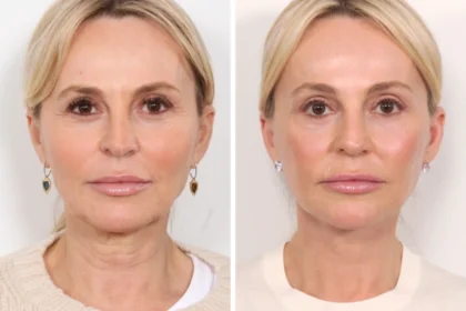 Best Plastic Surgeon in Dubai: Key Factors to Consider Before Getting a Thread Lift
