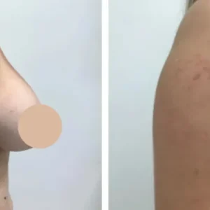 breast lift in dubai