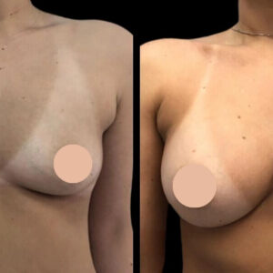 How Much Does Breast Augmentation in Dubai Cost?