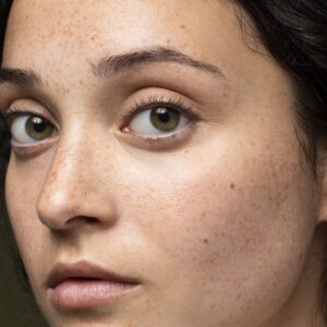 Acne Treatment In Dubai