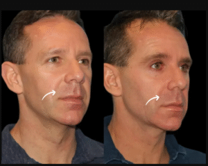 Sculptra Fillers Treatment in Dubai