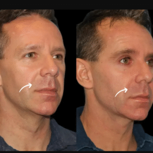 Sculptra Fillers Treatment in Dubai