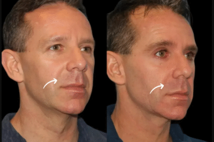 Sculptra Fillers Treatment in Dubai