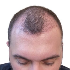Hair Transplant in Dubai