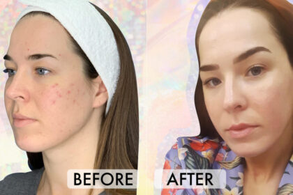 Whitening Injection: Benefits & Price in Pakistan