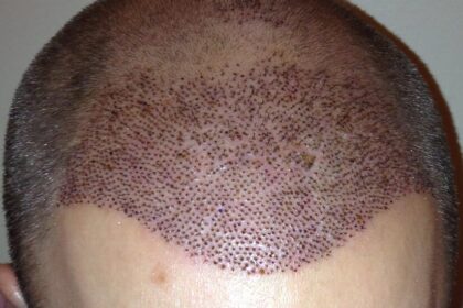 What is the Best age to Get a Hair Transplant