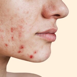 Acne Treatment In Dubai