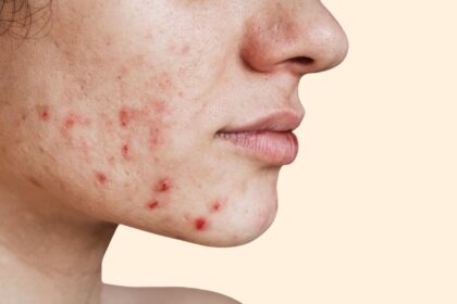 Acne Treatment In Dubai