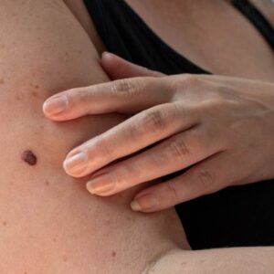 Say Goodbye to Unwanted Moles: Your Friendly Guide to Mole Removal in London