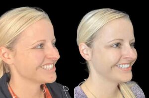 Is Botox in Dubai Worth It? Real Results and Reviews