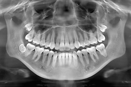 Dental X-Ray - What Are Dental X-Rays?