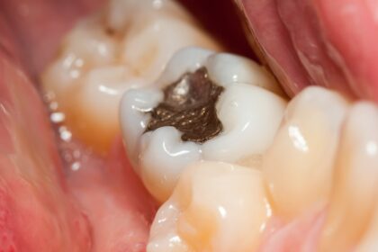 Dental Fillings: Types, Procedures, Benefits, and Aftercare Explained