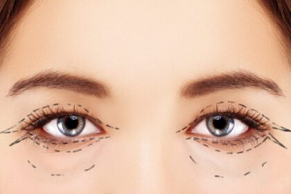 eye bag surgery