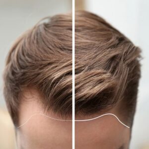 Curious about hair transplantation in Dubai cost? Discover detailed pricing, clinic options, packages, and what results you can expect from a hair transplant in Dubai.