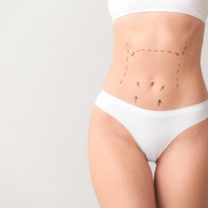 Liposuction in Dubai