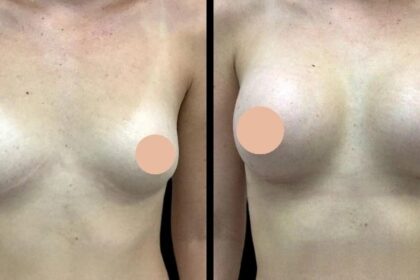 Breast augmentation in dubai