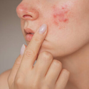 Does Acne Scar Treatment Cause Redness