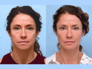Top Benefits of Thread Lifts According to the Best Doctors in Dubai