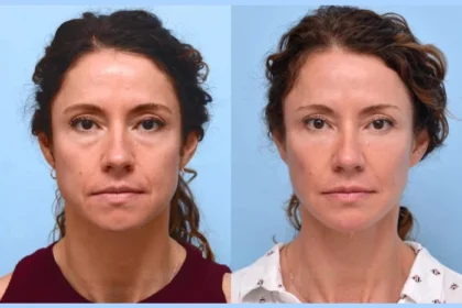 Top Benefits of Thread Lifts According to the Best Doctors in Dubai