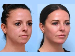 Thread Lift Treatment in Dubai: The Secret to Non-Surgical Lifting