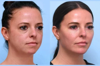 Thread Lift Treatment in Dubai: The Secret to Non-Surgical Lifting
